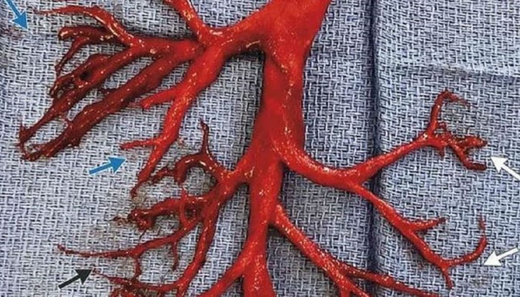 Warnung vor Blutgerinnseln: So sieht ein Blutgerinnsel aus, wenn FLÜSSIGES Blut in Ihrem Körper zu einer halbfesten gallertartigen Masse wird