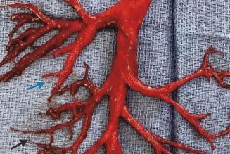 Warnung vor Blutgerinnseln: So sieht ein Blutgerinnsel aus, wenn FLÜSSIGES Blut in Ihrem Körper zu einer halbfesten gallertartigen Masse wird