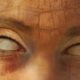 Phantom-Eye-Syndrom: Wenn Menschen Ohne Augen Noch Sehen Können
