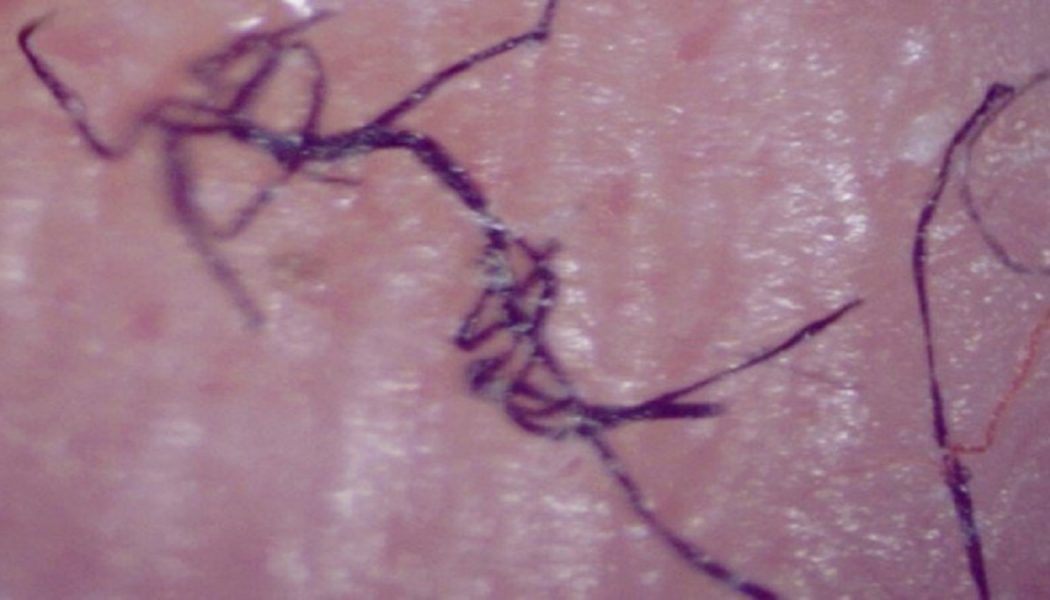 Morgellons-Krankheit: Wenn Etwas Unter Die Haut Kriecht
