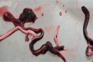 Einbalsamierer Finden Venen Und Arterien, Die Mit „Nie Zuvor Gesehenen“ Erschreckend Großen Blutgerinnseln Gefüllt Sind