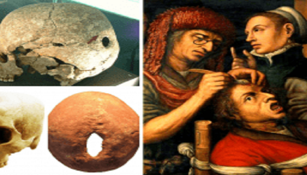 Die Alten Russen Bohrten Vor 7000 Jahren Löcher In Die Schädel Von Menschen, Entweder Für Operationen Oder Rituale
