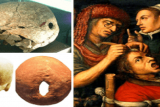 Die Alten Russen Bohrten Vor 7000 Jahren Löcher In Die Schädel Von Menschen, Entweder Für Operationen Oder Rituale