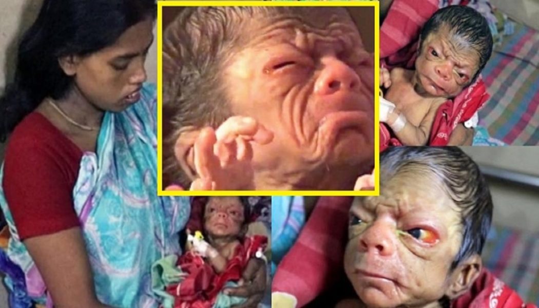 Beobachten Sie Das Seltsame Baby – Ein Kleiner Junge Aus Bangladesch Wurde Mit Einer Seltenen Genetischen Störung Geboren, Die Dazu Führt, Dass Er Wie Ein Mann Aussieht.