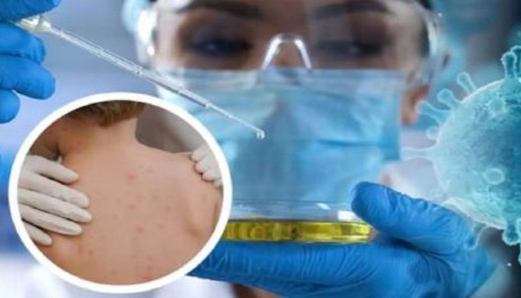 Monkeypox: Von der Simulation 2021 zur Realität 2022?