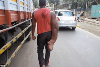 Inder mit 20 kg schwerem Arm wird von zu Hause verwiesen, weil er als „Sohn des Teufels“ gilt