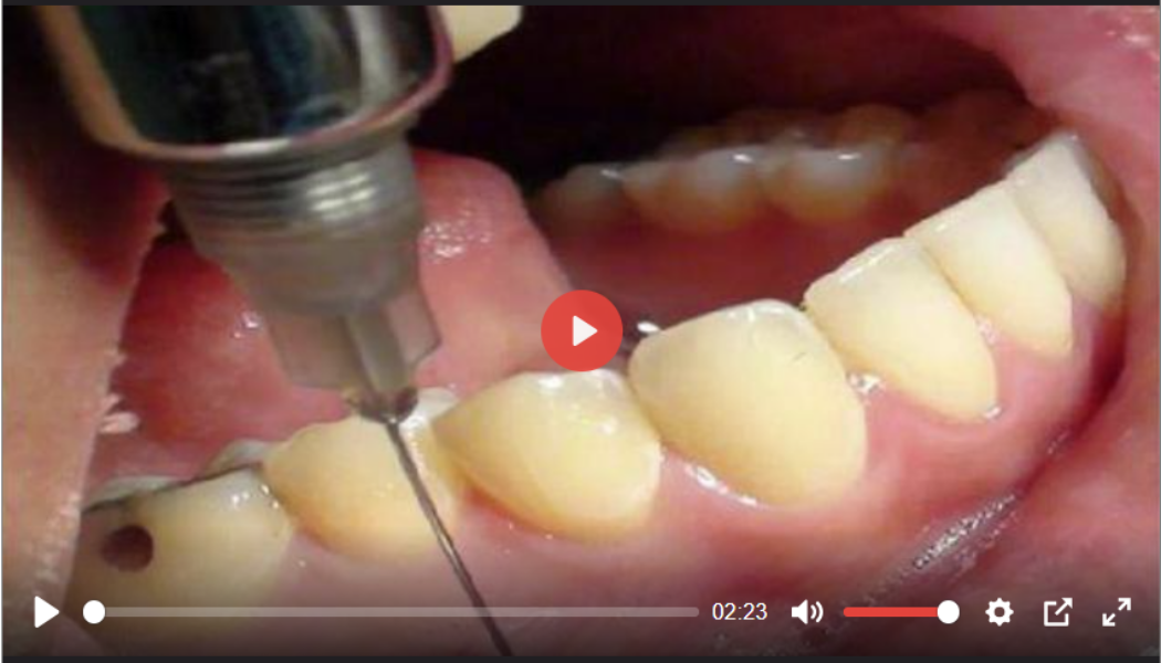 Warnung: Beim intramuskulären Schmerzmittel des Zahnarztes wird Graphenoxid verabreicht