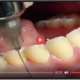 Warnung: Beim intramuskulären Schmerzmittel des Zahnarztes wird Graphenoxid verabreicht